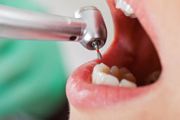 Best Emergency Dental Care for Sports Injuries in Berry Creek, CA